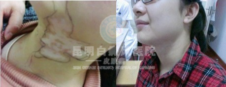 白癜风自我诊断方法有哪些