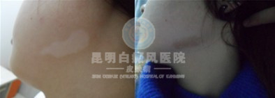 面部白癜风如何诊断