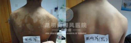 白癜风不治有哪些危害