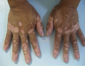 肢端型白癜风在治疗时要注意什么