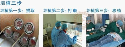 攻克白癜风治疗新高度,大小白斑高效同治