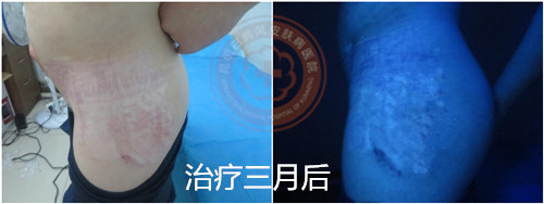 攻克白癜风治疗新高度,大小白斑高效同治