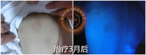 单一抹药难见效,推荐308光疗直达白斑病灶!