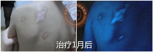 单一抹药难见效,推荐308光疗直达白斑病灶!