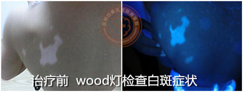 单一抹药难见效,推荐308光疗直达白斑病灶!