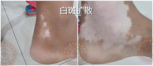 进展期白癜风治疗三大误区